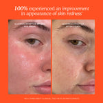 Before and after comparison of skin redness with a clinical test result on an orange background. [Shared]